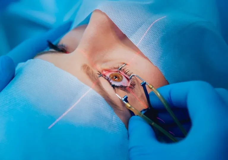 Laser Cataract Surgery