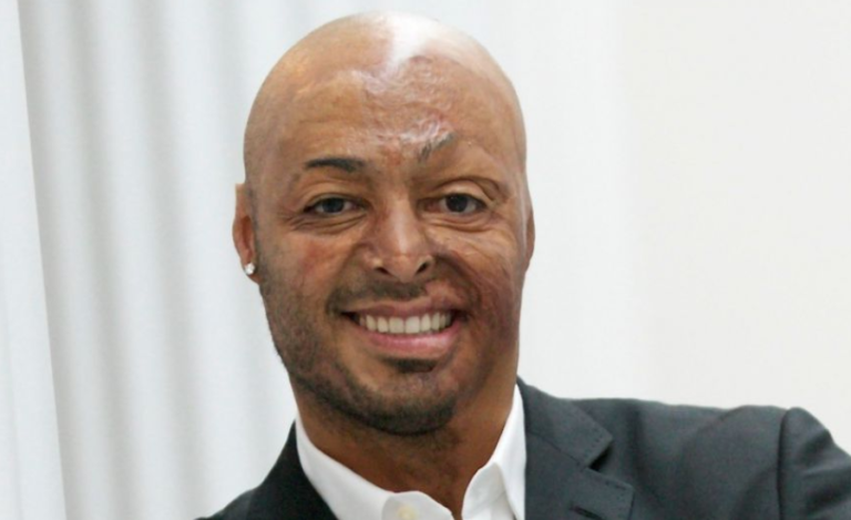 Famous Faces Living With Noonan Syndrome